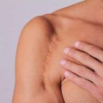 Scar correction Scar correction