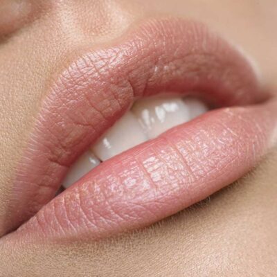 Lippen aufspritzen mit Hyaluron